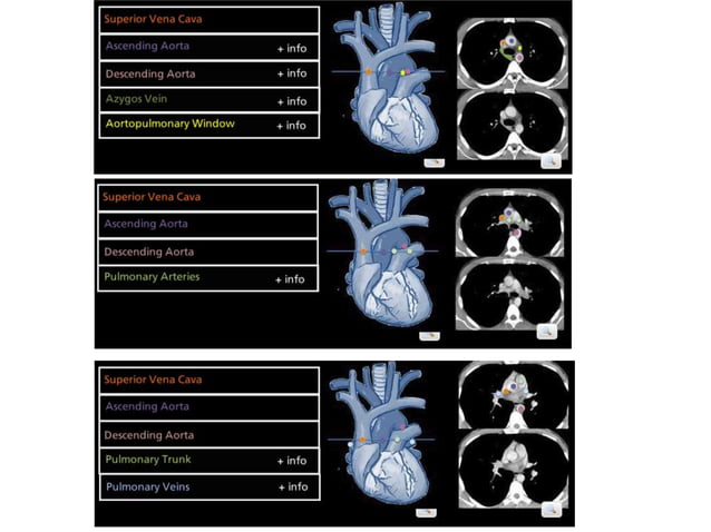 Lymph node anatomy for pet ct | PPT