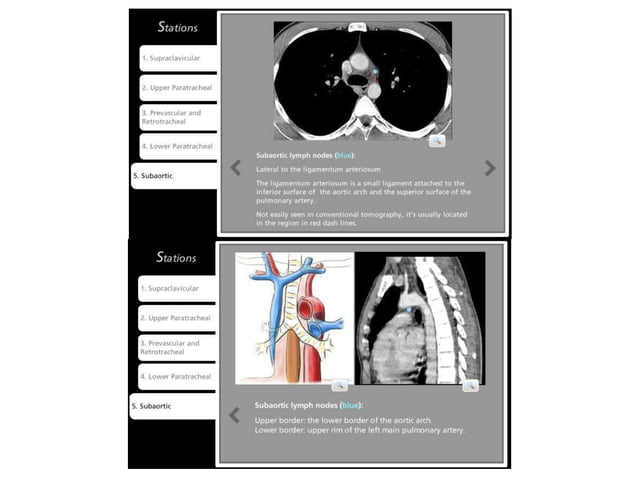 Lymph node anatomy for pet ct | PPT