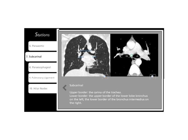 Lymph node anatomy for pet ct | PPT
