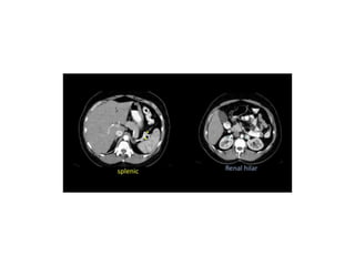 Lymph node anatomy for pet ct | PPTX