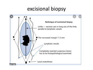 excisional biopsy
 