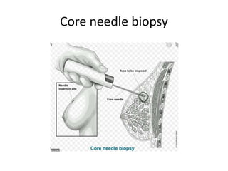 Core needle biopsy
 