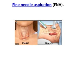 Fine needle aspiration (FNA).
 