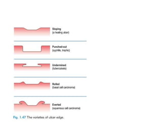 Lymph node, Lump, & Ulcer Examination.pptx