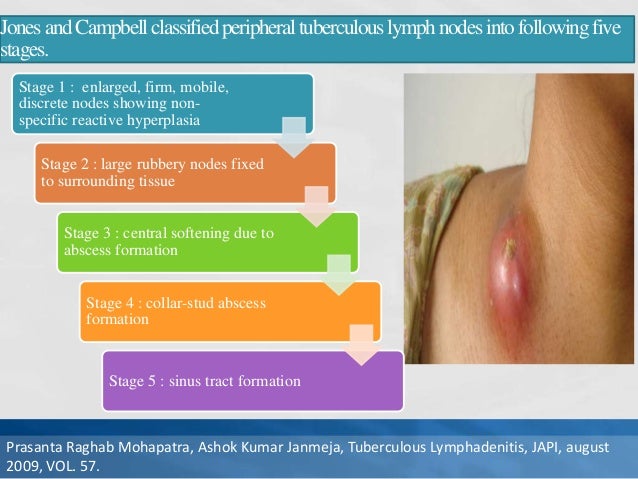 shotty lymph nodes groin