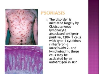 The disorder is
mediated largely by
CLA(cutaneous
lymphocyte
associated antigen)-
positive, CD8+ T cells
with type 1 cytokines
(interferon-g,
interleukin-2, and
lymphotoxin); these
cells may be
activated by an
autoantigen in skin
 