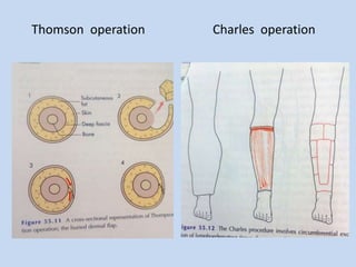 Thomson operation Charles operation
 