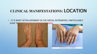 CLINICAL MANIFESTATIONS: LOCATION
• : IT IS MOST OFTEN APPARENT IN THE DISTAL EXTREMITIES, PARTICULARLY
OVER THE DORSUM OF THE FOOT OR HAND.
 