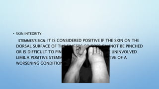 • SKIN INTEGRITY:
STEMMER’S SIGN: IT IS CONSIDERED POSITIVE IF THE SKIN ON THE
DORSAL SURFACE OF THE FINGERS OR TOES CANNOT BE PINCHED
OR IS DIFFICULT TO PINCH COMPARED WITH THE UNINVOLVED
LIMB.A POSITIVE STEMMER SIGN CAN BE INDICATIVE OF A
WORSENING CONDITION.
 