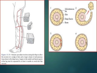 lymphoedema basics and management plan .ppt