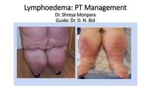 Lymphoedema: PT Management
Dr. Shreya Monpara
Guide: Dr. D. N. Bid
 