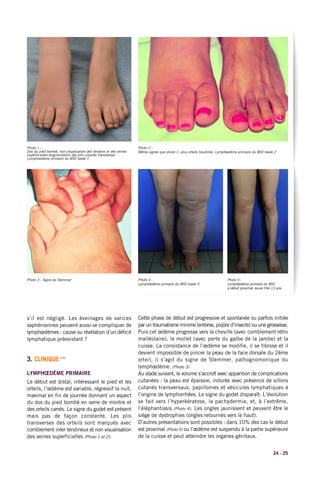 Photo 3 : Signe de Stemmer
Photo 1 :
Dos du pied bombé, non visualisation des tendons et des veines
superficielles Augmentation des plis cutanés transverses.
Lymphoedème primaire du MID stade 1
Photo 2 :
Même signes que photo 1, plus orteils boudinés. Lymphœdème primaire du MID stade 2
24 - 25
s’il est négligé. Les éveinages de varices
saphéniennes peuvent aussi se compliquer de
lymphœdèmes : cause ou révélation d’un déficit
lymphatique préexistant ?
3. CLINIQUE(10)
LYMPHŒDÈME PRIMAIRE
Le début est distal, intéressant le pied et les
orteils, l’œdème est variable, régressif la nuit,
maximal en fin de journée donnant un aspect
du dos du pied bombé en verre de montre et
des orteils carrés. Le signe du godet est présent
mais pas de façon constante. Les plis
transverses des orteils sont marqués avec
comblement inter tendineux et non visualisation
des veines superficielles (Photo 1 et 2).
Cette phase de début est progressive et spontanée ou parfois initiée
par un traumatisme minime (entorse, piqûre d’insecte) ou une grossesse.
Puis cet œdème progresse vers la cheville (avec comblement rétro
malléolaire), le mollet (avec perte du galbe de la jambe) et la
cuisse. La consistance de l’œdème se modifie, il se fibrose et il
devient impossible de pincer la peau de la face dorsale du 2ème
orteil, il s’agit du signe de Stemmer, pathognomonique du
lymphœdème. (Photo 3)
Au stade suivant, le volume s’accroît avec apparition de complications
cutanées : la peau est épaissie, indurée avec présence de sillons
cutanés transversaux, papillomes et vésicules lymphatiques à
l’origine de lymphorrhées. Le signe du godet disparaît. L’évolution
se fait vers l’hyperkératose, la pachydermie, et, à l’extrême,
l’éléphantiasis (Photo 4). Les ongles jaunissent et peuvent être le
siège de dystrophies (ongles retournés vers le haut).
D’autres présentations sont possibles : dans 10% des cas le début
est proximal (Photo 5) ou l’œdème est suspendu à la partie supérieure
de la cuisse et peut atteindre les organes génitaux.
Photo 5 :
Lymphœdème primaire du MID
à début proximal Jeune fille 13 ans
Photo 4 :
Lymphœdème primaire du MIG stade 3
 