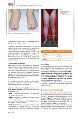 Chez l’enfant l’œdème a une consistance élastique,
dépressible sans godet. (Photo 6)
Dans ce cas le diagnostic est plus difficile et il est
impératif de rechercher une cause de compression par
scanner abdomino-pelvien et examens biologiques.
Chez l’enfant il est important de noter tous les autres
signes pathologiques pour déterminer s’il s’agit d’un
lymphœdème isolé ou associé à d’autres anomalies afin
d’améliorer la prise en charge et de susciter une
consultation génétique, 5% des lymphœdèmes primaires
étant héréditaires.
LYMPHŒDÈME SECONDAIRE
Après un temps de latence très variable après l’évènement
causal, il débute en général d’un côté, à la racine de la
cuisse puis il descend plus ou moins rapidement vers
la distalité. Il n’y a pas de signe de Stemmer quand le
pied n’est pas touché. Mais, il peut aussi débuter par
le pied et être bilatéral d’emblée et s’accompagner, plus
fréquemment que le lymphœdème primaire, d’un œdème
des organes génitaux. (Photo 7)
Le lymphœdème secondaire a la même symptomatologie
que le lymphœdème primaire mais il n’est pas associé
à d’autres malformations vasculaires.
L’évolution naturelle du lymphœdème se fait en trois
stades et degré de sévérité selon la dernière classification
proposée par l’ISL. (11)
• Stade I : augmentation de volume s’atténuant à la
surélévation du membre
• Stade II : l’élévation ne réduit plus le volume et l’œdème
est toujours dépressible.
Il se produit des modifications cutanées à type de fibrose
traduit par le signe de Stemmer.
• Stade III : éléphantiasis avec disparition du caractère
dépressible de l’œdème, apparition de troubles
trophiques cutanés (papillomes, vésicules) et unguéaux.
DEGRÉS DE SÉVÉRITÉ AUGMENTATION DE VOLUME
Minimal < 20%
Modéré 20 - 40 %
Marqué > 40 %
SYMPTÔMES
Un lymphœdème n’est pas douloureux, mais il entraîne,
quand il est important, des lourdeurs du membre, des
douleurs articulaires et/ou rachidiennes avec une gêne
fonctionnelle pouvant aller jusqu’à l’impotence. Lorsqu’il
devient douloureux, il faut rechercher une surinfection,
une thrombose veineuse profonde, une affection tumorale
et, en cas de lymphœdème secondaire, une récidive
cancéreuse, mais aussi une radiculalgie, une artérite ou
une sténose veineuse post-radique.
Le lymphœdème est aggravé par le surpoids et par
l’insuffisance veineuse qu’il est nécessaire de rechercher
systématiquement.
4. EXAMENS COMPLÉMENTAIRES
En général la clinique suffit pour faire le diagnostic d’un
lymphœdème mais certaines situations nécessitent le
concours d’explorations complémentaires qui sont : la
lymphoscintigraphie isotopique, l’écho-Doppler veineux
et artériel, l’échographie, le scanner. La lymphangiographie
directe avec injection de produit de contraste iodé a été
abandonnée car elle aggrave le lymphœdème.
Elle est remplacée par la lymphoscintigraphie isotopique,
examen atraumatique réalisable dès l’enfance. Elle consiste
en l’injection dans le premier espace interdigital de 0,2
www.sfmv.fr
Les lymphœdèmes du membre inférieur
FORMATION
MÉDICALE
CONTINUE
Photo 6 : Lymphœdème congénital bilatéral enfant
Photo 7 :
Lymphœdème secondaire
du MID avec début
de bilatéralisation
localisation proximo-distale
Pas de signe de Stemmer
 