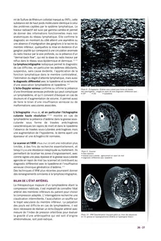Photo 8 : Échographie. Œdème sous-cutané sous forme de travées
très anéchogènes : images en rayon de miel.Diagnostic différentiel avec :
• TVP • IVS • lipoedème
26 - 27
ml de Sulfure de Rhénium colloïdal marqué au 99Tc, cette
substance est de haut poids moléculaire identique à celui
des protéines captées par le système lymphatique. Le
traceur radioactif est suivi par gamma caméra et permet
de donner des informations fonctionnelles mais non
anatomiques du réseau lymphatique. Elle confirme le
diagnostic en montrant du côté atteint une asymétrie ou
une absence d’imprégnation des ganglions à la racine du
membre inférieur, quelquefois la mise en évidence d’un
ganglion poplité qui correspond à une circulation anormale
du radio traceur par la voie profonde, ou la présence d’un
“dermal-back flow”, qui est la stase du radio traceur par
reflux dans le réseau sous épidermique et dermique.(12-13)
La lymphoscintigraphie isotopique permet le diagnostic
de cas difficiles, en particulier les œdèmes débutants,
suspendus, sans cause évidente, l’appréciation de la
fonction lymphatique dans le membre controlatéral,
l’estimation du degré d’atteinte lymphatique, mais aussi
le diagnostic différentiel avec le lipœdème et la recherche
d’une association lymphœdème et lipœdème.(14)
L’écho-Doppler veineux confirme ou infirme la présence
d’une thrombose veineuse profonde qui peut compliquer
un lymphœdème, et qu’il convient d’évoquer en cas de
douleurs et d’augmentation de volume. Il permet aussi
de faire le bilan d’une insuffisance veineuse ou de
malformations vasculaires associées.
L’échographie (Photo 8), et en particulier l’échographie
cutanée haute résolution (15,16)
montre en cas de
lymphœdème la présence d’œdème dans la graisse sous-
cutanée sous forme de travées anéchogènes
caractéristiques (en rayons de miel) et dans le lipœdème
l’absence de travées sous-cutanées anéchogènes mais
une augmentation de l’hypoderme, le derme ayant une
épaisseur et une échogénicité normales.
Le scanner et l’IRM (Photo 9 et 10) ont une indication plus
limitée, à des fins de recherche essentiellement, et
lorsqu’il y a une résistance inexpliquée au traitement. Ils
permettent de localiser les zones d’engraissement, avec
comme signes une peau épaissie et la graisse sous-cutanée
agencée en rayon de miel (au scanner) et contribuent au
diagnostic différentiel avec le lipœdème et l’insuffisance
veineuse chronique génératrice d’œdème.(17)
Des techniques d’IRM plus récentes pourraient donner
des renseignements similaires à la lymphoscintigraphie.
BILAN DE L’ÉTAT ARTÉRIEL
La thérapeutique majeure d’un lymphœdème étant la
compression médicale, il est impératif de connaître l’état
artériel des membres inférieurs du patient pour choisir
la compression adaptée. L’interrogatoire recherche une
claudication intermittente, l’auscultation un souffle sur
le trajet vasculaire du membre inférieur. La palpation
des pouls est difficile en cas de lymphœdème, il est
donc nécessaire de réaliser un écho-Doppler artériel avec
mesure de l’index de pression orteil/bras pour évaluer
la gravité d’une artériopathie qui est soit d’origine
athéromateuse, soit post-radique.
Photo 9 : Scanner
• Peau épaissie
• Graisse sous-cutanée : agencement en rayon de miel
• diagnostic différentiel avec lipœdème
Photo 10 : IRM Caractérisation tissulaire grâce au choix des séquences
En T2: graisse en hyposignal(noire) Œdème en hypersignal (blanc)
 