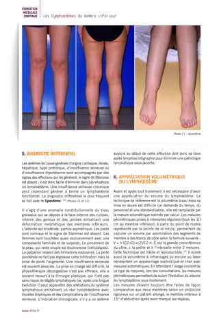 www.sfmv.fr
Les lymphœdèmes du membre inférieur
FORMATION
MÉDICALE
CONTINUE
Photo 11 : lipoedème
5. DIAGNOSTIC DIFFÉRENTIEL
Les œdèmes de cause générale d’origine cardiaque, rénale,
hépatique, hypo protidique, d’insuffisance veineuse ou
d’insuffisance thyroïdienne sont accompagnés par des
signes des affections qui les génèrent, le signe de Stemmer
est absent : il est donc facile d’éliminer dans ces situations
un lymphœdème. Une insuffisance veineuse chronique
peut cependant générer à terme un lymphœdème
fonctionnel. Le diagnostic différentiel le plus fréquent
se fait avec le lipœdème. (18)
(Photos 11 et 12)
Il s’agit d’une anomalie constitutionnelle du tissu
graisseux qui se dépose à la face externe des cuisses,
interne des genoux et des jambes entraînant une
déformation inesthétique des membres inférieurs.
L’atteinte est bilatérale, parfois asymétrique. Les pieds
sont normaux et le signe de Stemmer est absent. Les
femmes sont touchées quasi exclusivement avec une
composante familiale et de surpoids. Le pincement de
la peau, qui reste souple est douloureuse (cellulalgies).
La palpation ressent des formations nodulaires. La perte
pondérale ne fait pas régresser cette infiltration mais la
prise de poids l’augmente. Une insuffisance veineuse
est souvent associée. La prise en charge est difficile, la
physiothérapie décongestive n’est pas efficace, elle a
souvent recours à la chirurgie plastique, qui n’est pas
sans risque de dégâts lymphatiques car, après une longue
évolution il peut apparaître des altérations du système
lymphatique entraînant un réel lymphœdème avec
troubles trophiques et des complications de l’insuffisance
veineuse. L’indication chirurgicale, s’il y a un œdème
associé au début de cette affection doit donc se faire
après lymphoscintigraphie pour éliminer une pathologie
lymphatique sous-jacente.
6. APPRÉCIATION VOLUMÉTRIQUE
DU LYMPHŒDÈME
Avant et après tout traitement il est nécessaire d’avoir
une appréciation du volume du lymphœdème. La
technique de référence est la volumétrie à eau mais sa
mise en œuvre est difficile car demande du temps, du
personnel et une standardisation, elle est remplacée par
la mesure volumétrique estimée par calcul. Les mesures
périmétriques prises à intervalles réguliers (tous les 10
cm au membre inférieur), à partir du point de repère
représenté par la pointe de la rotule, permettent de
calculer un volume par assimilation des segments de
membre à des troncs de cône selon la formule suivante :
V = h (C2+Cc+c2)/12 π. C est la grande circonférence
du cône, c la petite et h l’intervalle entre 2 mesures.
Cette technique est fiable et reproductible.(19)
Il existe
aussi la volumétrie à infrarouges ou encore au laser
nécessitant un appareillage sophistiqué et cher avec
mesures automatiques. En attendant l’usage courant de
ce type de mesures, lors des consultations, les mesures
périmétriques permettent de suivre l'évolution du volume
du lymphœdème sous traitement.
Les mesures doivent toujours être faites de façon
comparative aux deux membres selon un protocole
rigoureux sur un patient allongé, le membre inférieur à
15° d’abduction après avoir marqué les repères.
 
