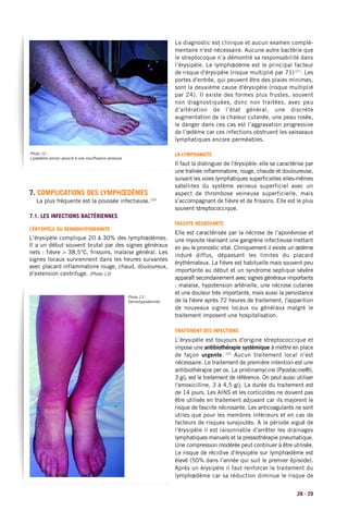 28 - 29
7. COMPLICATIONS DES LYMPHŒDÈMES
La plus fréquente est la poussée infectieuse.(20)
7.1. LES INFECTIONS BACTÉRIENNES
L’ÉRYSIPÈLE OU DERMOHYPODERMITE
L’érysipèle complique 20 à 30% des lymphœdèmes.
Il a un début souvent brutal par des signes généraux
nets : fièvre > 38,5°C, frissons, malaise général. Les
signes locaux surviennent dans les heures suivantes
avec placard inflammatoire rouge, chaud, douloureux,
d’extension centrifuge. (Photo 13)
Le diagnostic est clinique et aucun examen complé-
mentaire n'est nécessaire. Aucune autre bactérie que
le streptocoque n’a démontré sa responsabilité dans
l’érysipèle. Le lymphœdème est le principal facteur
de risque d'érysipèle (risque multiplié par 71) (21)
. Les
portes d'entrée, qui peuvent être des plaies minimes,
sont la deuxième cause d'érysipèle (risque multiplié
par 24). Il existe des formes plus frustes, souvent
non diagnostiquées, donc non traitées, avec peu
d’altération de l’état général, une discrète
augmentation de la chaleur cutanée, une peau rosée,
le danger dans ces cas est l’aggravation progressive
de l’œdème car ces infections obstruent les vaisseaux
lymphatiques encore perméables.
LA LYMPHANGITE
Il faut la distinguer de l’érysipèle: elle se caractérise par
une traînée inflammatoire, rouge, chaude et douloureuse,
suivant les voies lymphatiques superficielles elles-mêmes
satellites du système veineux superficiel avec un
aspect de thrombose veineuse superficielle, mais
s’accompagnant de fièvre et de frissons. Elle est le plus
souvent streptococcique.
FASCIITE NÉCROSANTE
Elle est caractérisée par la nécrose de l’aponévrose et
une myosite réalisant une gangrène infectieuse mettant
en jeu le pronostic vital. Cliniquement il existe un œdème
induré diffus, dépassant les limites du placard
érythémateux. La fièvre est habituelle mais souvent peu
importante au début et un syndrome septique sévère
apparaît secondairement avec signes généraux importants
: malaise, hypotension artérielle, une nécrose cutanée
et une douleur très importante, mais aussi la persistance
de la fièvre après 72 heures de traitement, l'apparition
de nouveaux signes locaux ou généraux malgré le
traitement imposent une hospitalisation.
TRAITEMENT DES INFECTIONS
L’érysipèle est toujours d'origine streptococcique et
impose une antibiothérapie systémique à mettre en place
de façon urgente. (22)
Aucun traitement local n’est
nécessaire. Le traitement de première intention est une
antibiothérapie per os. La pristinamycine (Pyostacine®),
3 g/j, est le traitement de référence. On peut aussi utiliser
l'amoxicilline, 3 à 4,5 g/j. La durée du traitement est
de 14 jours. Les AINS et les corticoïdes ne doivent pas
être utilisés en traitement adjuvant car ils majorent le
risque de fasciite nécrosante. Les anticoagulants ne sont
utiles que pour les membres inférieurs et en cas de
facteurs de risques surajoutés. A la période aiguë de
l'érysipèle il est raisonnable d'arrêter les drainages
lymphatiques manuels et la pressothérapie pneumatique.
Une compression modérée peut continuer à être utilisée.
Le risque de récidive d’érysipèle sur lymphœdème est
élevé (50% dans l’année qui suit le premier épisode).
Après un érysipèle il faut renforcer le traitement du
lymphœdème car sa réduction diminue le risque de
Photo 12 :
Lipœdème ancien associé à une insuffisance veineuse
Photo 13 :
Dermohypodermite
 