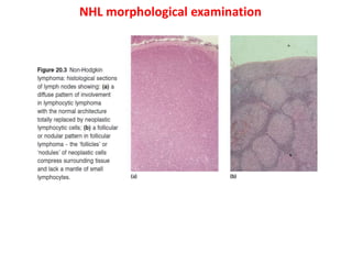 NHL morphological examination
 
