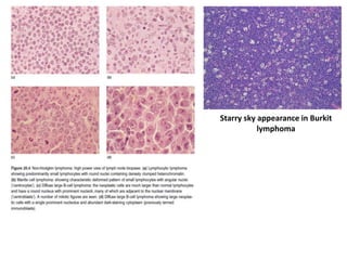 Starry sky appearance in Burkit
lymphoma
 