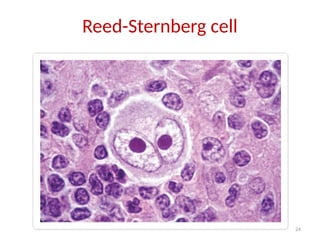 24
Reed-Sternberg cell
 