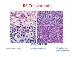25
lacunar cell
(mixed cellularity) (nodular sclerosis) (lymphocyte
predominance)
RS Cell variants
 