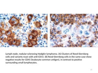 27
Lymph node, nodular-sclerosing Hodgkin lymphoma. (A) Clusters of Reed-Sternberg
cells and variants react with anti-CD15. (B) Reed-Sternberg cells in the same case show
negative results for CD45 (leukocyte common antigen), in contrast to positive
surrounding small lymphocytes.
A
B
 
