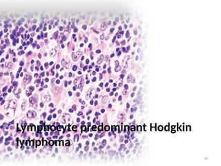 30
Lymphocyte predominant Hodgkin
lymphoma
 