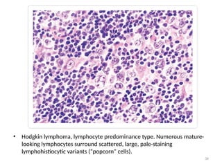 34
• Hodgkin lymphoma, lymphocyte predominance type. Numerous mature-
looking lymphocytes surround scattered, large, pale-staining
lymphohistiocytic variants (“popcorn” cells).
 