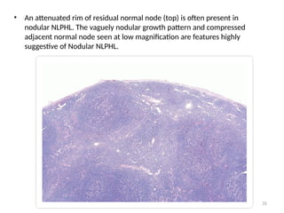35
• An attenuated rim of residual normal node (top) is often present in
nodular NLPHL. The vaguely nodular growth pattern and compressed
adjacent normal node seen at low magnification are features highly
suggestive of Nodular NLPHL.
 