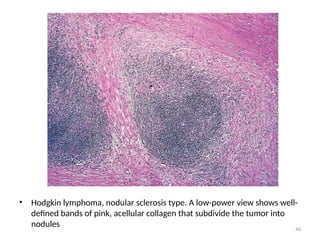 40
• Hodgkin lymphoma, nodular sclerosis type. A low-power view shows well-
defined bands of pink, acellular collagen that subdivide the tumor into
nodules
 