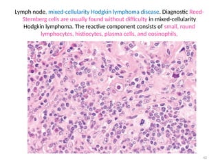 42
Lymph node, mixed-cellularity Hodgkin lymphoma disease. Diagnostic Reed-
Sternberg cells are usually found without difficulty in mixed-cellularity
Hodgkin lymphoma. The reactive component consists of small, round
lymphocytes, histiocytes, plasma cells, and eosinophils,
 