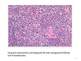 46
Frequent mononuclear and diagnostic RS cells; background infiltrate
rich in lymphocytes.
 