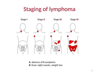 51
Stage I Stage II Stage III Stage IV
Staging of lymphoma
A: absence of B symptoms
B: fever, night sweats, weight loss
 