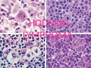 6
HODGKIN
LYMPHOMA
 