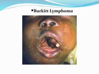 Burkitt Lymphoma
 