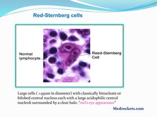 Large cells ( >45um in diameter) with classically binucleate or
bilobed central nucleus each with a large acidophilic central
nucleoli surrounded by a clear halo. “owl’s eye appearance”
Red-Sternberg cells
Medrockets.com
 