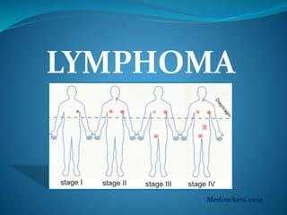 LYMPHOMA
Medrockets.com
 