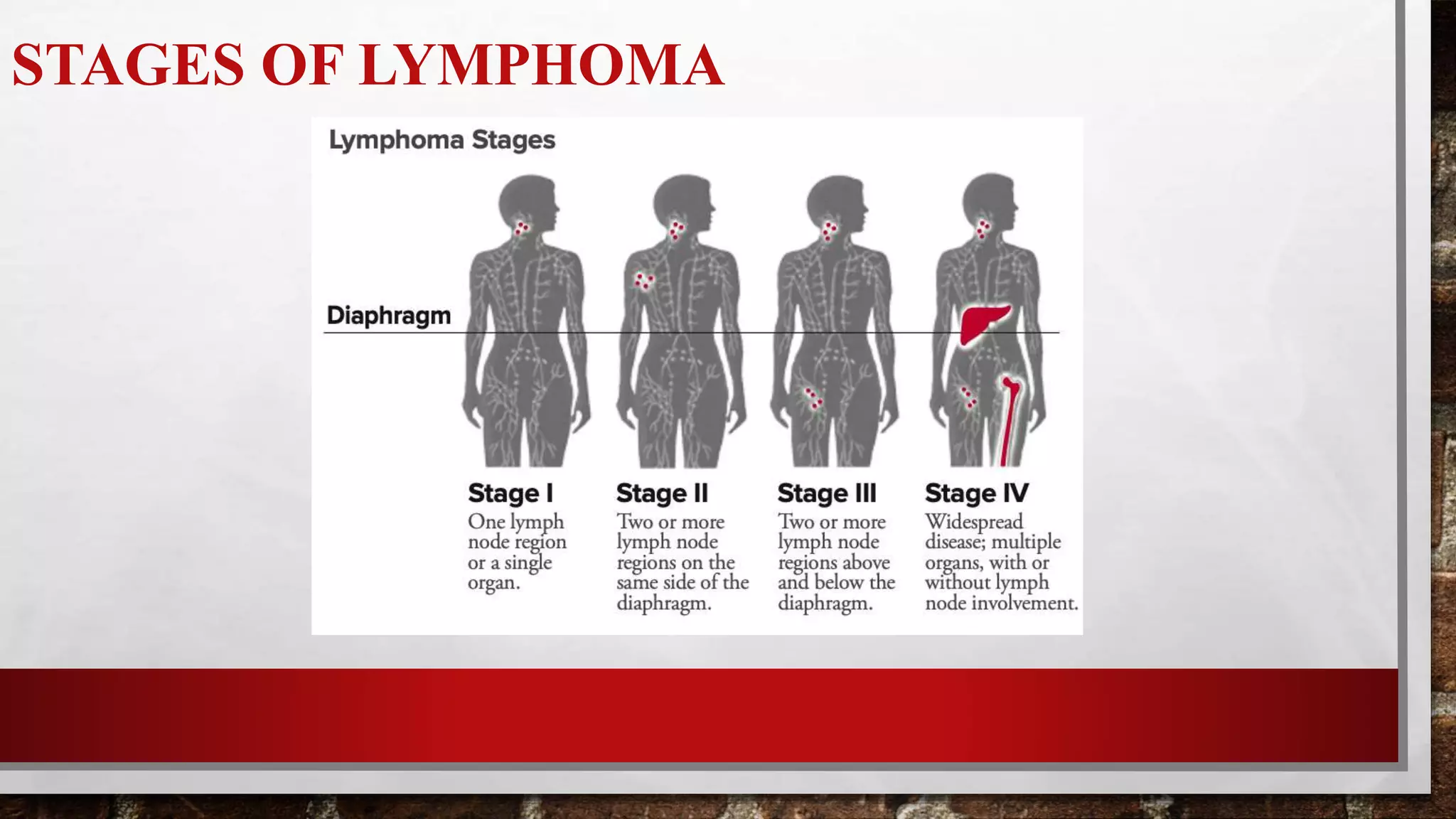 Lymphoma | PPTX