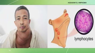 HODGKIN’S LYMPHOMA
10
 