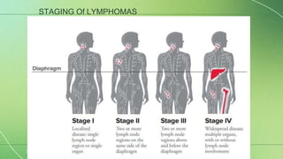 3
STAGING Of LYMPHOMAS
 
