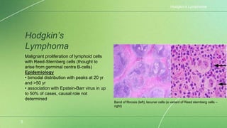 Hodgkin’s
Lymphoma
Hodgkin’s Lymphoma
5
Malignant proliferation of lymphoid cells
with Reed-Sternberg cells (thought to
arise from germinal centre B-cells)
Epidemiology
• bimodal distribution with peaks at 20 yr
and >50 yr
• association with Epstein-Barr virus in up
to 50% of cases, causal role not
determined
Band of fibrosis (left), lacunar cells (a variant of Reed sternberg cells –
right)
 