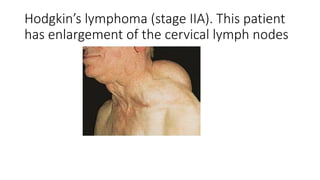Hodgkin’s lymphoma (stage IIA). This patient
has enlargement of the cervical lymph nodes
 
