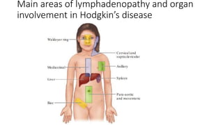 Main areas of lymphadenopathy and organ
involvement in Hodgkin’s disease
 