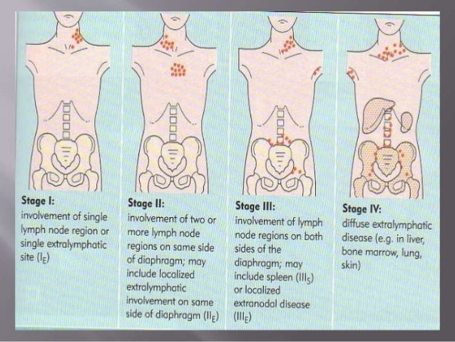 Lymphoma Clinical Feature Dx Dr Rajesh