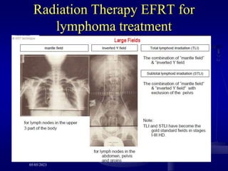 Radiation Therapy EFRT for
lymphoma treatment
05/05/2023
 