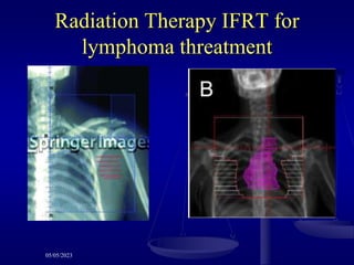 Radiation Therapy IFRT for
lymphoma threatment
05/05/2023
 