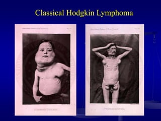 Classical Hodgkin Lymphoma
 