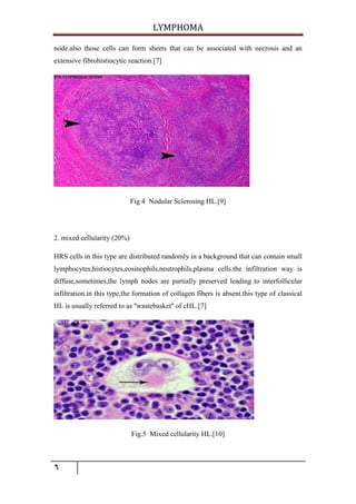 Feline Lymphoma Mixed Cellularity Type Reference: Lymphoma