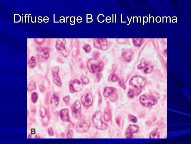 Lymphoma