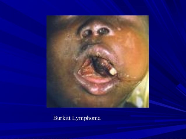 the clinical description of lymphoma Journal description clinical lymphoma & myeloma is the world's premier peer-reviewed, tumor-specific, clinical oncology journal devoted to publishing clinically. the clinical description of lymphoma Journal description clinical lymphoma & myeloma is the world's premier peer-reviewed, tumor-specific, clinical oncology journal devoted to publishing clinically.