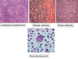 Lymphocyte predominant Nodular sclerosis Mixed cellularity
Reed-Sternberg Cell
 